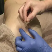 Séance de dry needling